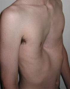 Pectus Excavatum et Méthode Lafay
